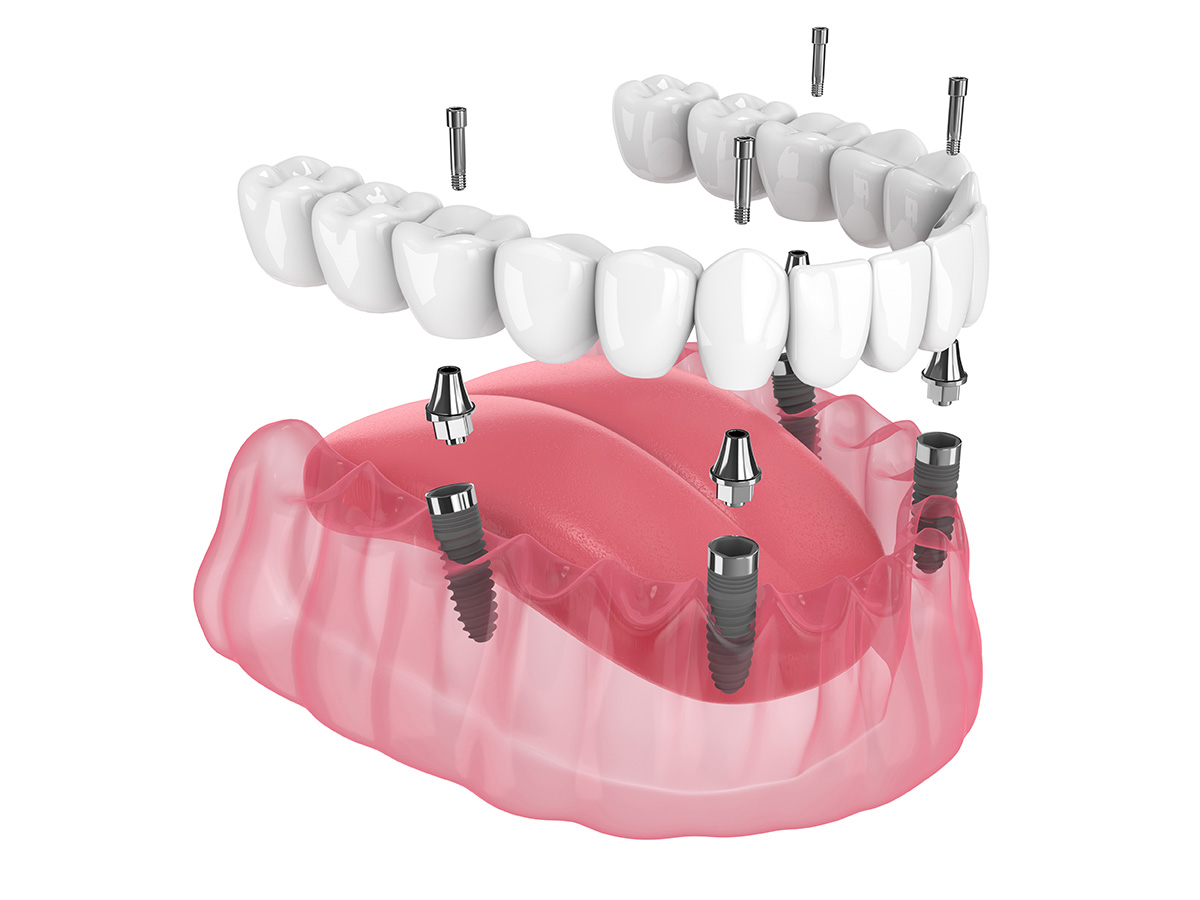 New teeth in one day diagram