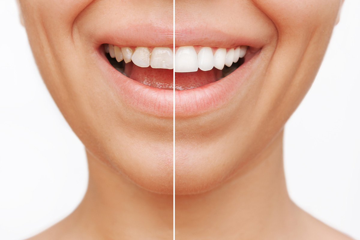 porcelain-veneers-before-after Before and after veneers