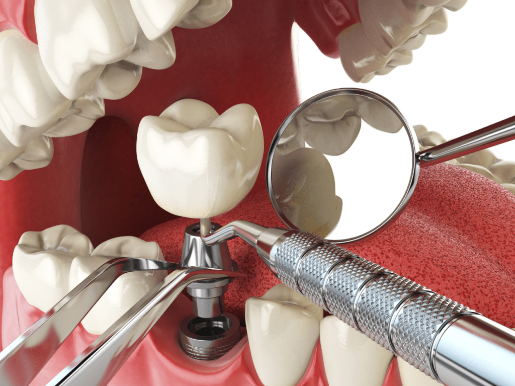 dental_implants_Laguna_Hills_dentist