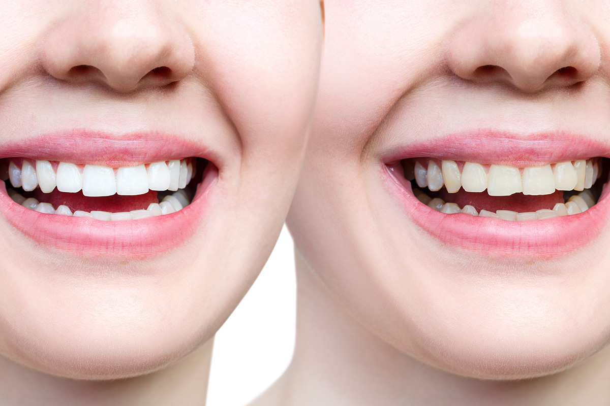 cosmetic-bonding-img-2 Cosmetic bonding for cosmetic dentistry