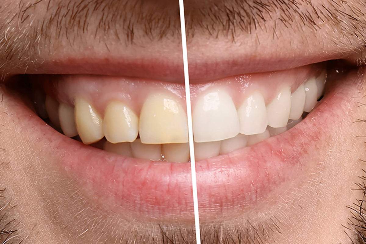 teeth-whitening-img-2 Teeth whitening for cosmetic dentistry