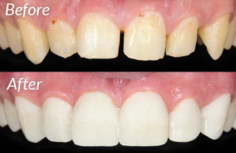 veneers-img Veneers cosmetic dentistry