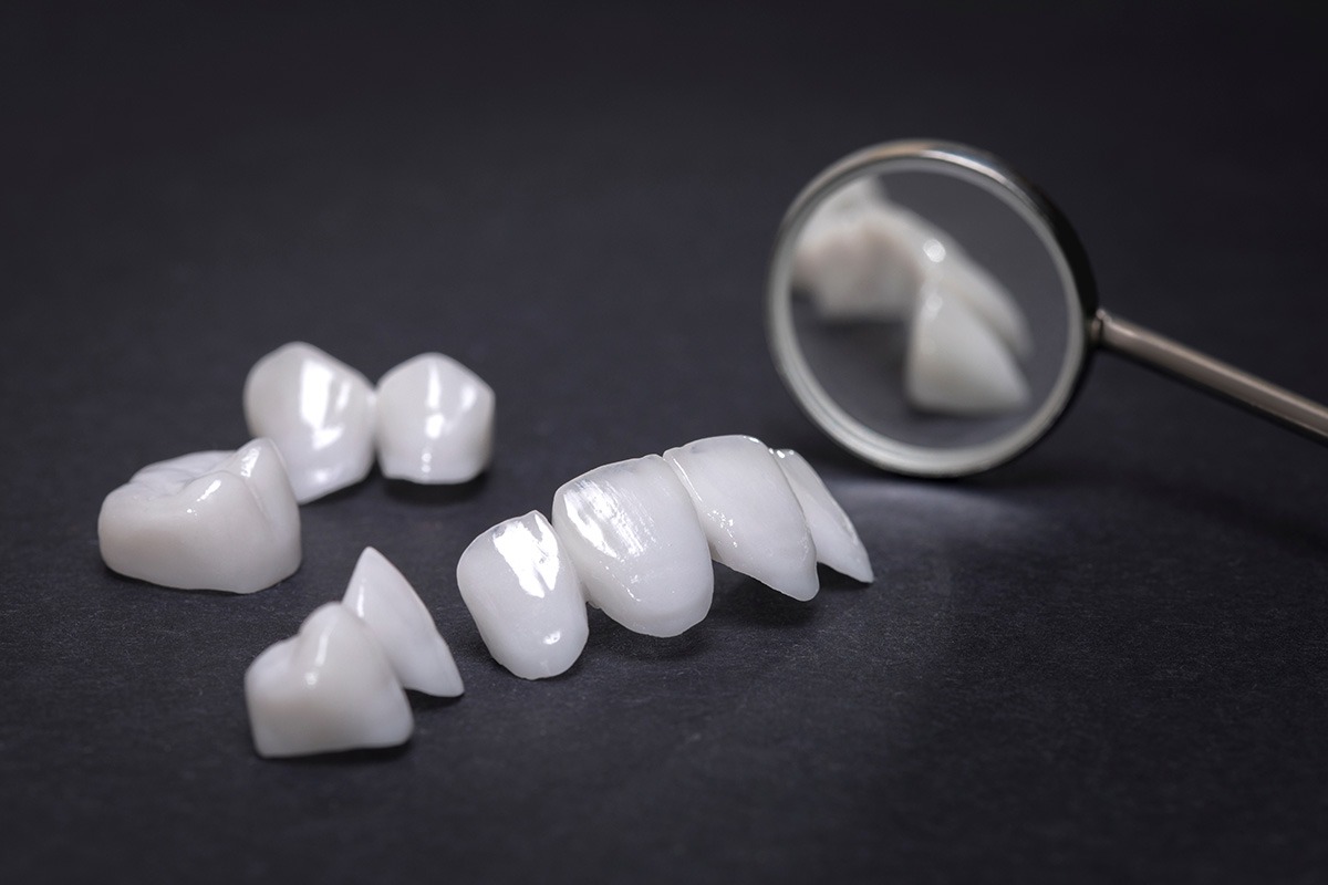 Dental veneers