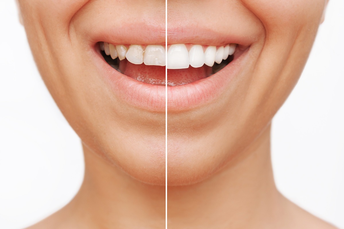 Before and after porcelain veneers
