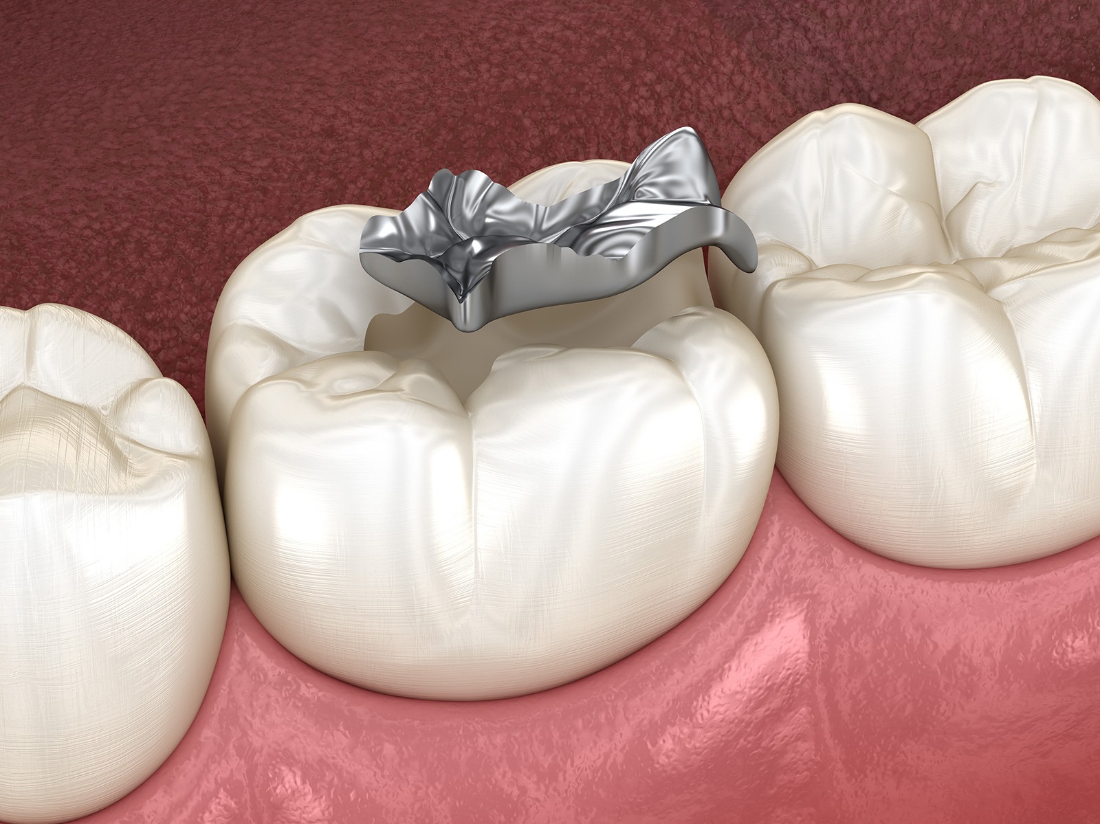 An amalgam filling removal