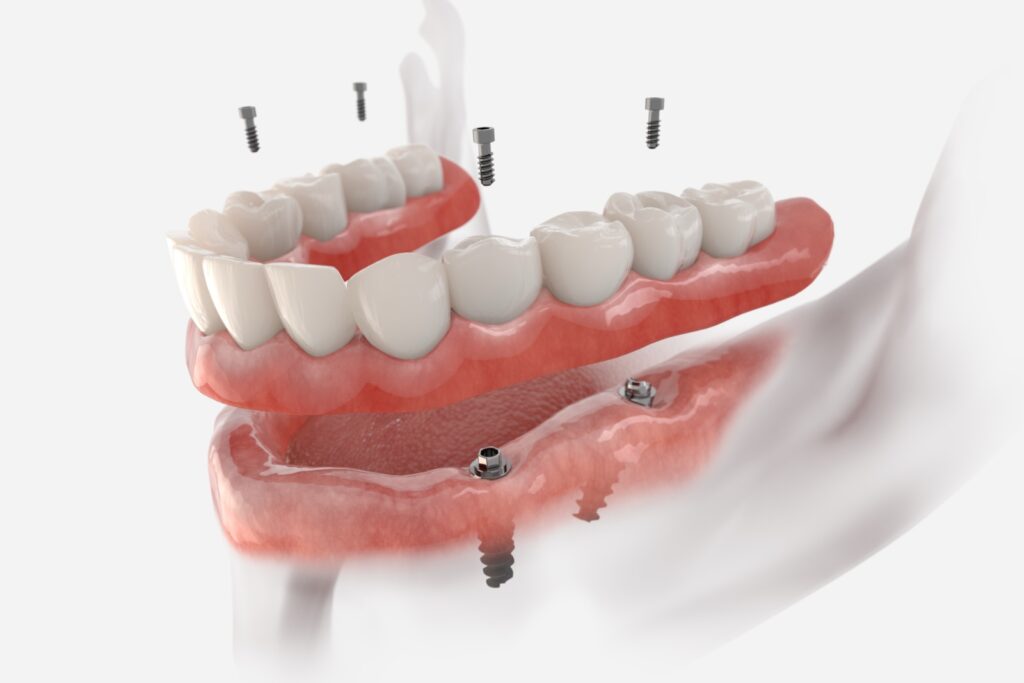 New teeth in one day